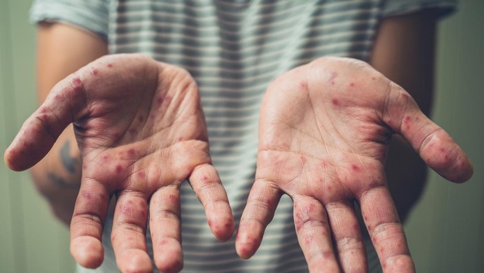 Eskalasi Kasus Hand, Foot, and Mouth Disease (HFMD) di Tanah Air: Sebuah Tinjauan Faktor-faktor Penyebabnya