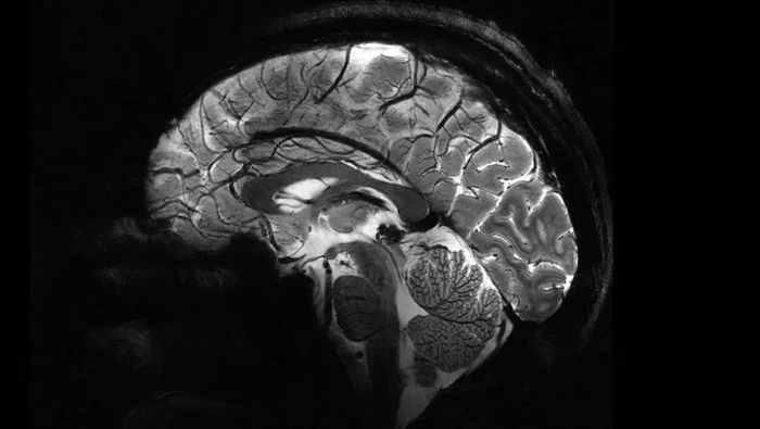 Era Baru Neuroimaging: Pemindai MRI Superkuat Buka Jendela ke Otak